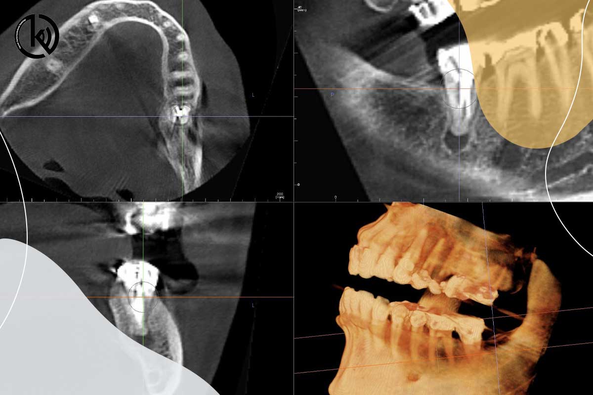 چگونه از اسکن سه بعدی در دندانپزشکی استفاده می‌شود؟