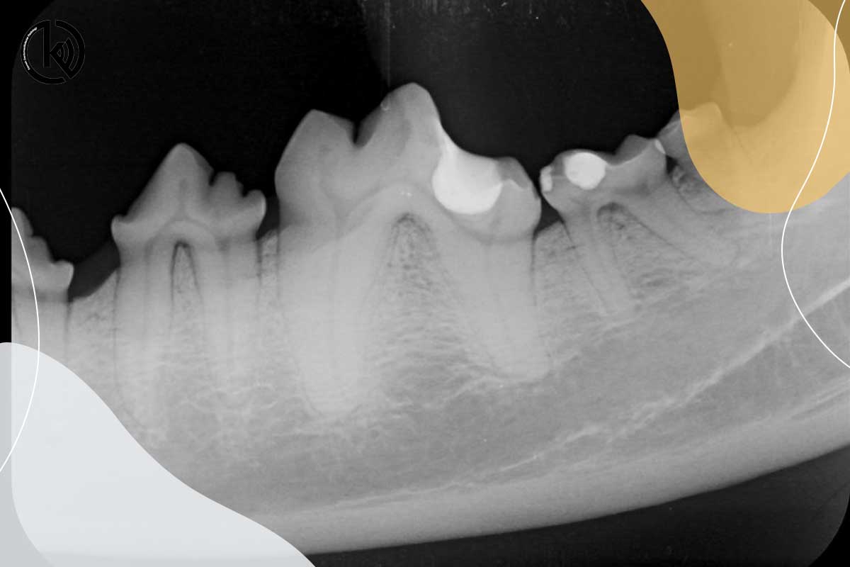 عکس رادیولوژی دندان