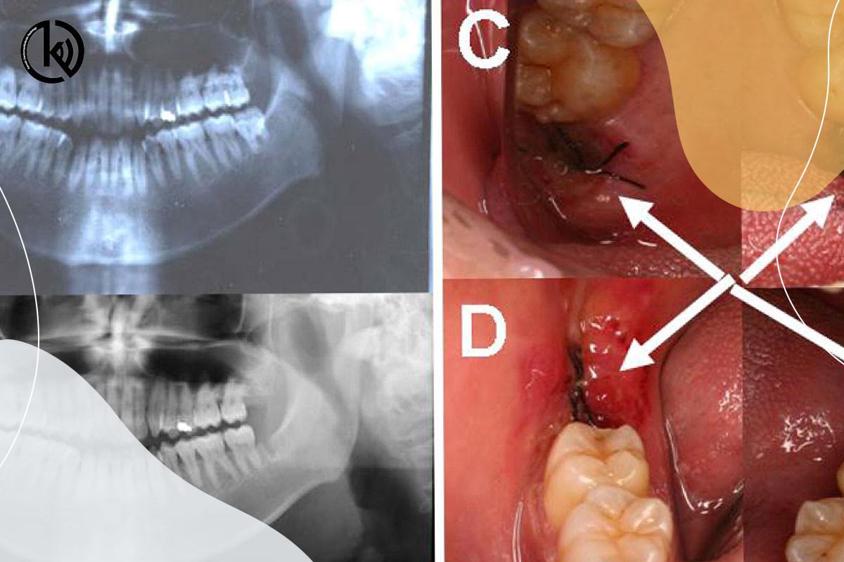 تشخیص التهاب در اشعه ایکس دندان